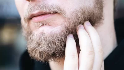 BEARD TRANSPLANT